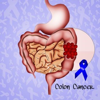 Colon cancer